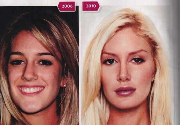 heidi montag plastic surgery cover. heidi montag plastic surgery.