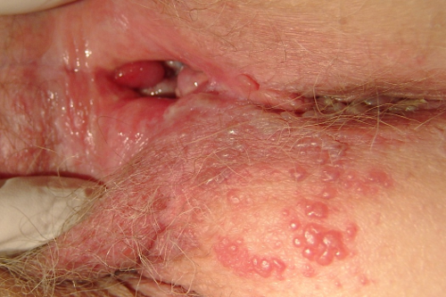 pengobatan herpes tradisional