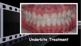 Underbite treatment, no jaw surgery, non extraction, class III, missing teeth, extracted teeth, Orthodontics, orthodontists, Clear, Invisible, Braces, Invisalign, underbite,class III, face mask, non-surgery, non-extraction, crossbite, overbite, class II, crooked, spaced, crowding, teeth, severe, jaw alignment, cosmetics, implants, children, dentists, dentistry, friendly, adults, children, family, Lawrenceville, Norcross, Buford, Hamilton Mill, Dacula, Auburn, Sugar Hill, Sugar Loaf, Doraville, Chamblee, Stone Mountain, Decatur, Collins Hill, Snellville, Suwanee, Grayson, Lilburn, Duluth, Cumming, Alpharetta, Marietta, Dekalb, Gwinnett, County, Atlanta, North Georgia, GA, Georgia, 30043, 30093, affordable, Vietnamese, Spanish, weekend, Saturday, appointments, Dr. Quang Nguyen, Georgia Orthodontic Care, Nguyen Orthodontics.