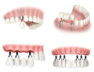 Mất nhiều răng có cần cấy ghép nhiều trụ implant?