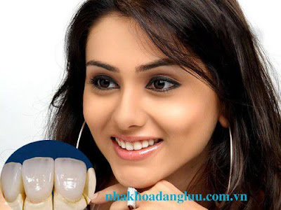 Bọc răng sứ kim loại có ưu điểm gì?