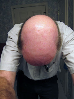 Top view of scalp before applying Efudex.