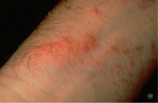 Image 1 used with permission of the American Academy of Dermatology National Library of Dermatologic Teaching Slides.