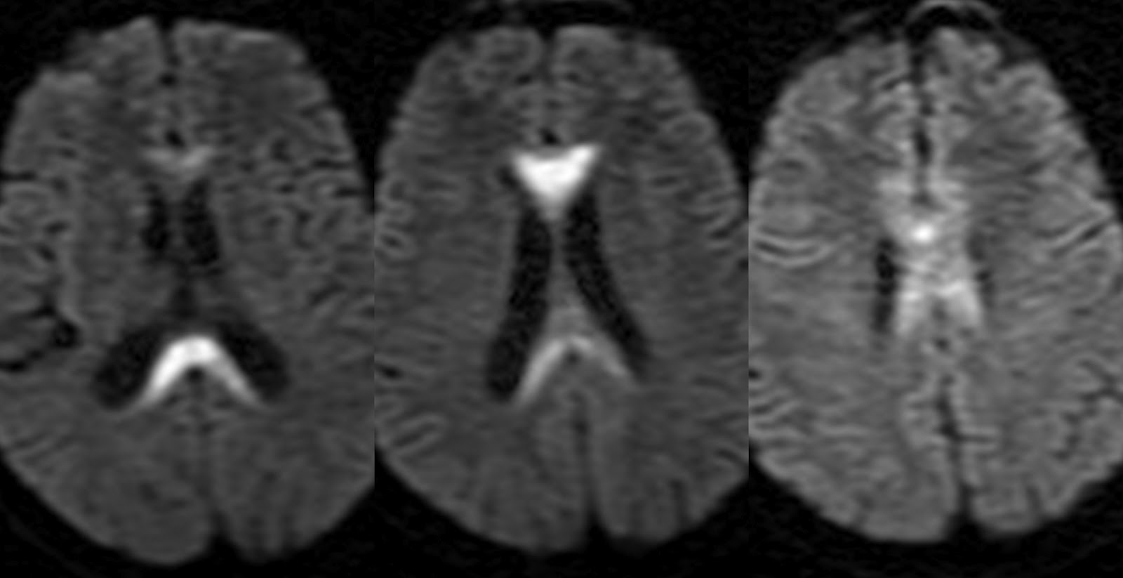 Dr Balaji Anvekar FRCR: Marchiafava Bignami Disease MRI