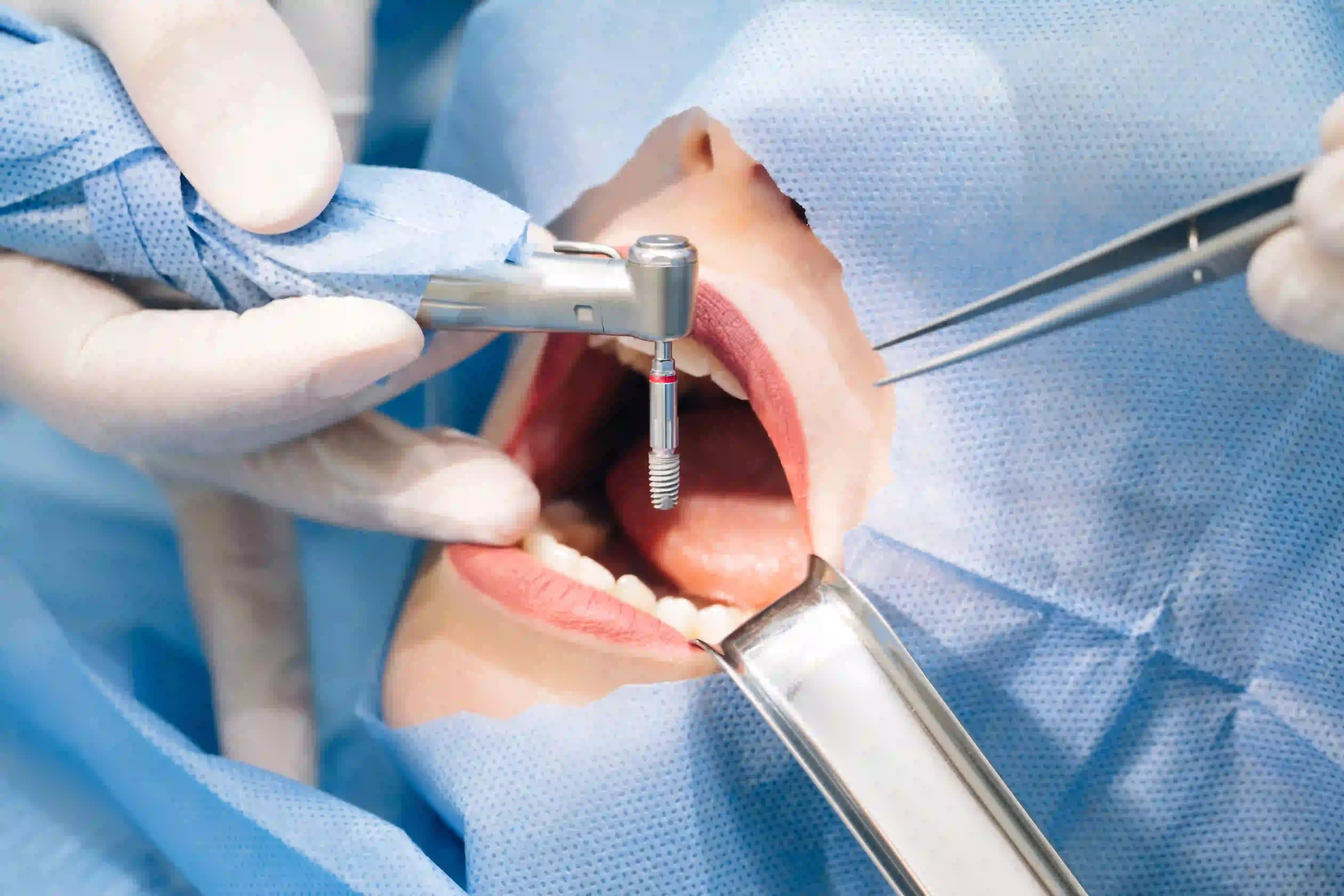 Oral surgeon performing dental implant surgery on a patient.