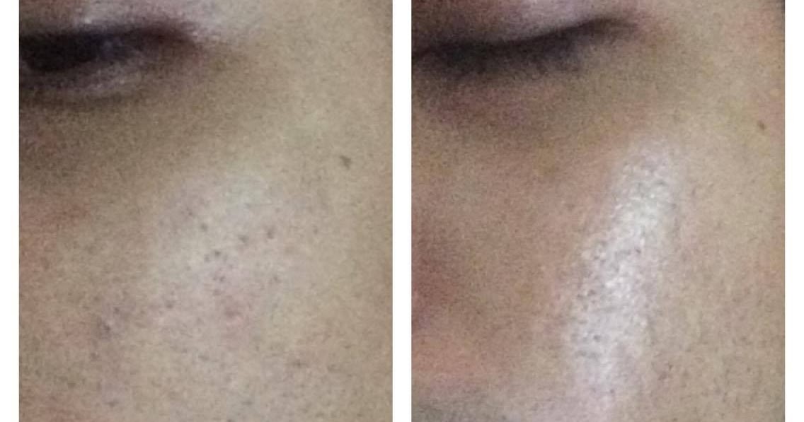 REVIEW : RAWATAN LASER MUKA (CARBON LASER PEEL TREATMENT)