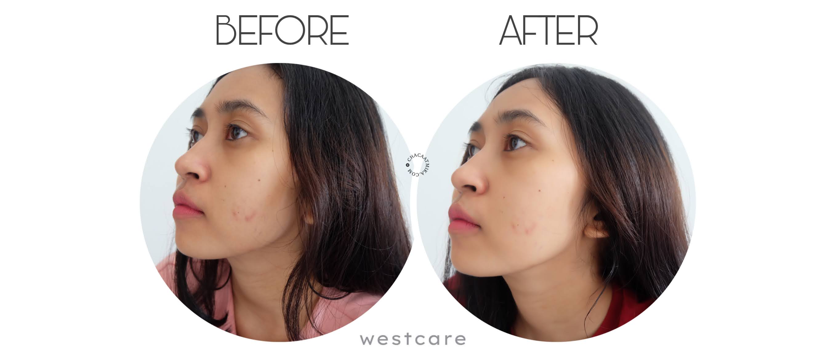 Before After Pemakaian Westcare Skincare