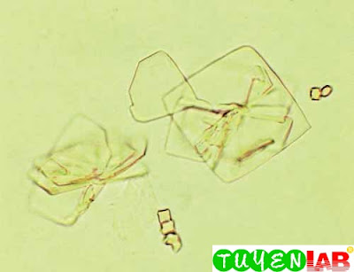 Uric acid and calcium oxalate crystals (500x)