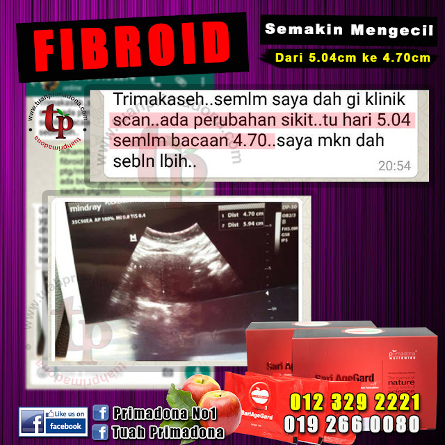 testimoni masalah fibroid sari agegard