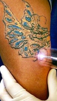 Tattoo Laser Removal