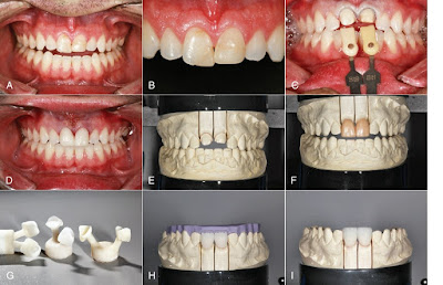 Lý do răng sứ có giá thành cao?
