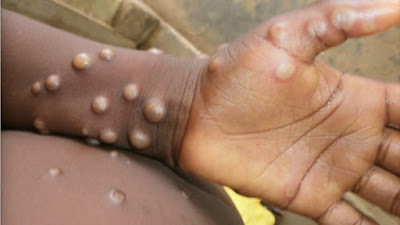 Lesões de varíola