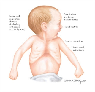   intercostal retractions, intercostal retractions ards, intercostal retractions treatment, intercostal recession definition, intercostal retractions causes, substernal retraction, intercostal retractions newborn, intercostal retractions in adults, intercostal retractions toddler