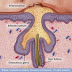 Causes of Acne