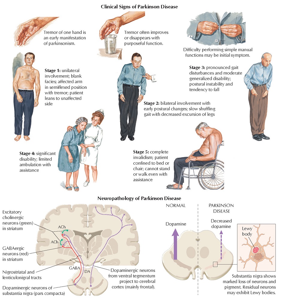 Parkinsonism: Symptoms and Defect