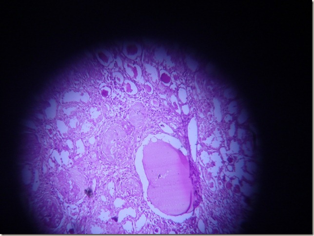 chronic pyelonephritis