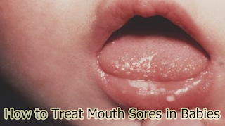 How to Treat Mouth Sores in Babies