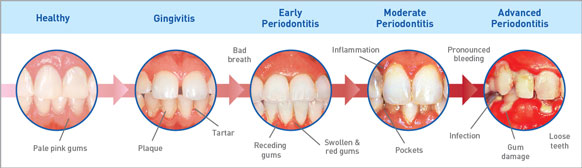 http://whitefielddentist.com/resources/learn-more-about-gum-disease/