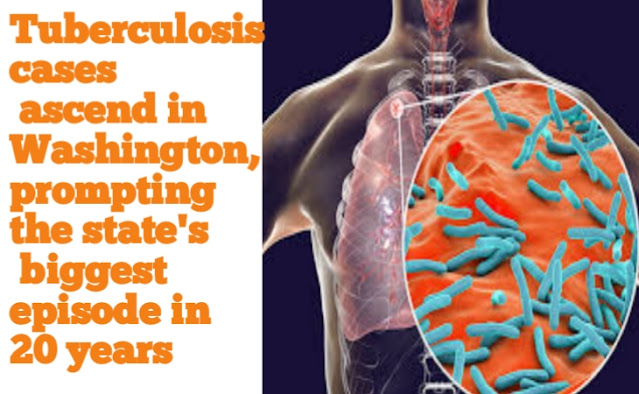 Tuberculosis cases ascend in Washington, prompting the state's biggest episode in 20 years