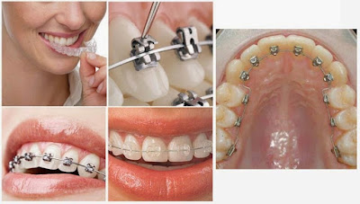 Quy trình thực hiện niềng răng mặt trong