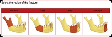 Maxillofacial trauma