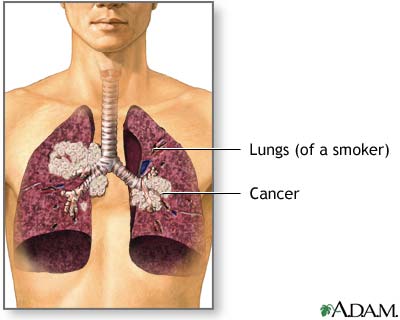 Esciencenewscomctlungcancerscreeningnocureallsmok