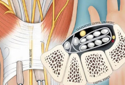 3 dấu hiệu về hội chứng ống cổ tay