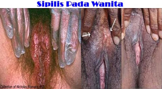 Ciri2 Penyakit Sipilis Wanita