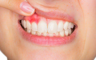 Sưng lợi chân răng - Nguyên nhân và cách chữa trị 1