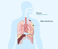 Mesothelioma Mesothelioma