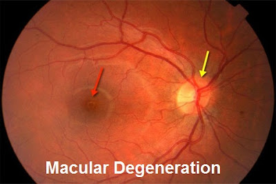 Macular Degeneration Causes, Diagnosis And Treatment