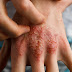 Home Remedies for Eczema: 5 Quick and Easy Solutions