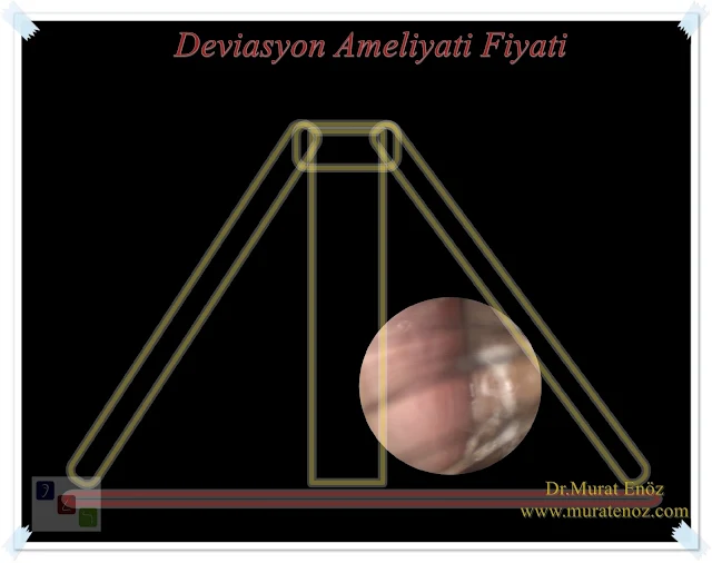 Deviasyon ameliyatı ücreti 2020 - Burun deviasyon ameliyatı fiyatı 2020 - Septum deviasyonu ameliyatı ücreti 2020 - Septum deviasyonu ameliyatı fiyatı 2020 - Burun kemiği eğriliği ameliyatı fiyatı 2019- Septoplasti ameliyatı ücreti 2020 - SMR ameliyatı ücreti 2020 - Deviasyon operasyonu ücreti 2020 - Burunda kıkırdak eğriliği ameliyatı ücreti 2020