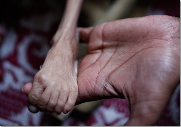 In this Friday, Nov. 20, 2009 photograph, a physiotherapist holds the leg of a seven year old child at a clinic run by a non-governmental organization to cater to victims of the gas tragedy in Bhopal, India. (AP Photo/Saurabh Das)