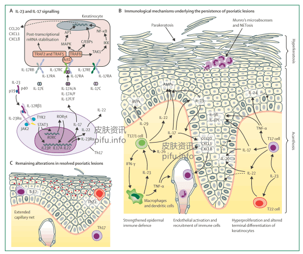 银屑病的免疫发病机制