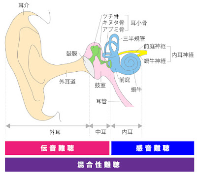 難聴の種類を表すイラスト。詳細は後述。