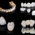 Có những loại răng sứ nào được áp dụng hiện nay?