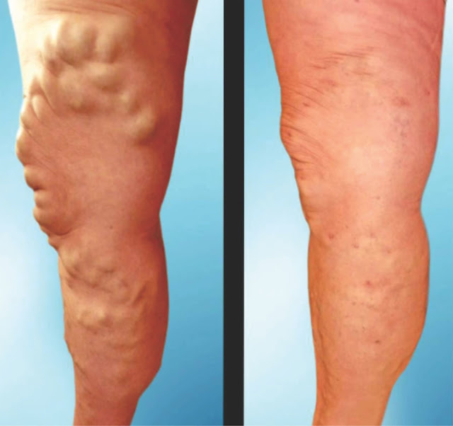 Amandeep Hospital & Clinics bring Laser Treatment for Varicose Veins  for the first time in Amritsar, Punjab
