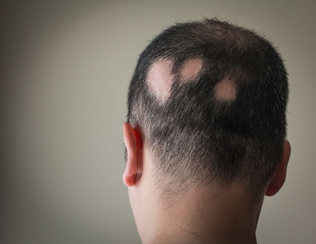  खालित्य ( Alopecia Areata )