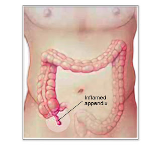 Nursing Care Plan for Acute Appendicitis