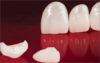 Phân tích răng sứ venus có tốt không từ bác sĩ-1 Phân tích răng sứ venus có tốt không từ bác sĩ-1