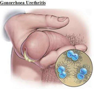 Penyakit kencing nanah berbahaya, obat penyakit gonore (kemaluan bernanah) yang ada di apotik, obat gonore (kencing nanah) dijual bebas, nama antibiotik untuk penyakit kencing nanah, penyakit gonore pdf, pengobatan sifilis raja singa, makalah penyakit gonore pdf, obat pilihan gonore, cara menyembuhkan penyakit kencing nanah secara alami, buah mengobati sipilis, obat di apotik untuk kencing nanah