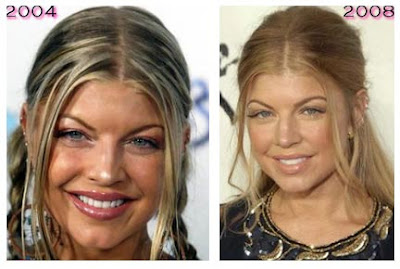 Fergie Plastic Surgery