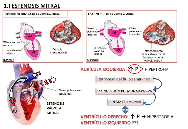 ESTENOSIS MITRAL