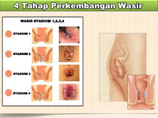 Wasir Yang Sudah Keluar