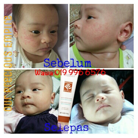 Testimoni Eczema Dan Ruam Bayi Hilang - KAK WAWA - Health 