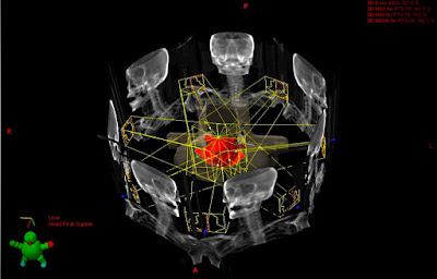 Best Radiotherapy in India