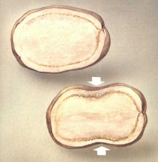 Кольцевая гниль картофеля (Clavibacter michiganensis subsp. sepedonicus)