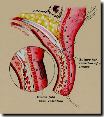 surgery to create upper eyelid crease in asian upper eyelid