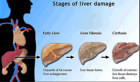 Yakratshoth ya Hepatitis B Rog ke karan Lakshan or Upchar